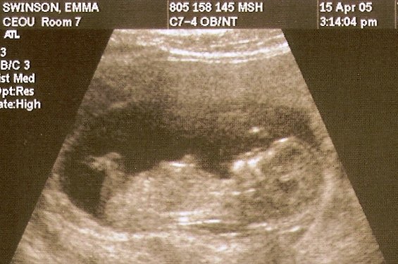 ULTRASOUND 2.2
